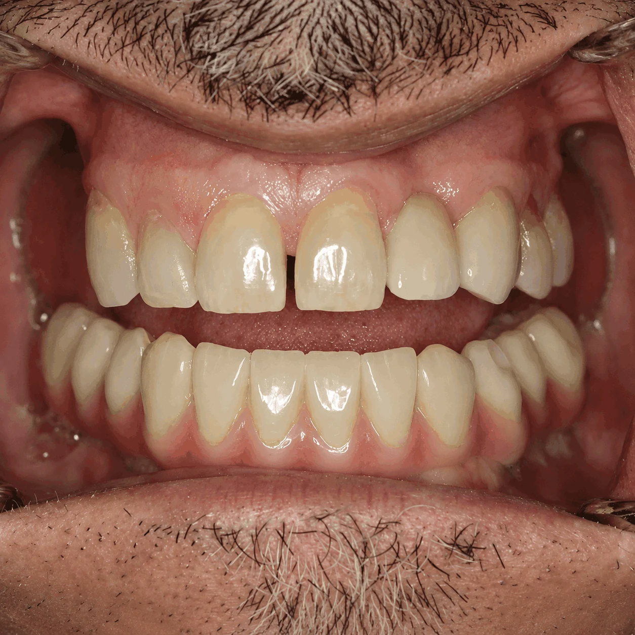 After treatment