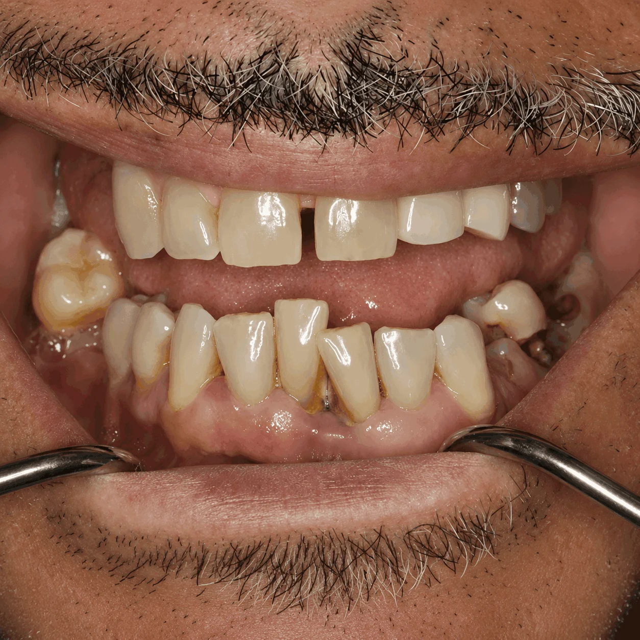 Before treatment