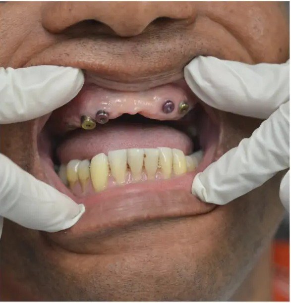 Before treatment