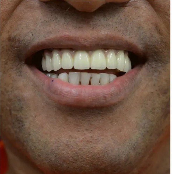 After treatment